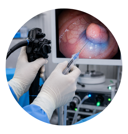 Endoscopic ADR Injection